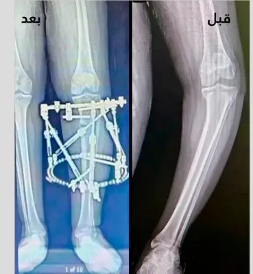 نجاح طبي متميز: فريق جراحة العظام بمدينة الملك سلمان يعيد قدرة المشي لشاب بعد تقوس حاد بالساق