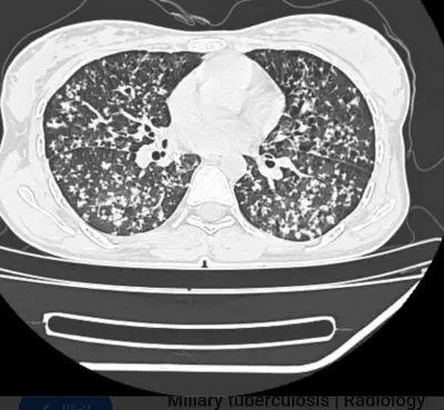 فريق طبي بمستشفى المانع بالأحساء ينقذ مريضاً مصاباً بسل رئوي منتشر ونقص حاد بالأكسجين