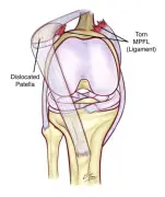 الشهراني يكشف تفاصيل إصابة حمد اليامي في مباراة الهلال والتعاون