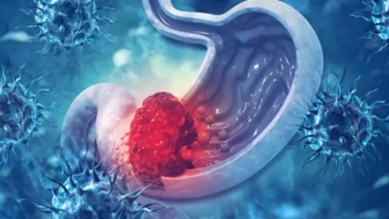 تطور بطيء لأورام سرطان المعدة مع تأخر ظهور الأعراض