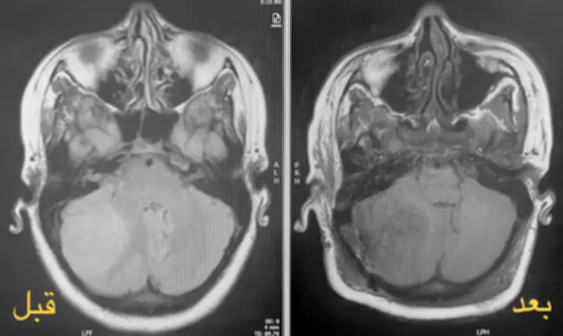 نجاح عملية استئصال ورم دماغي معقد لامرأة حامل في مدينة الملك سلمان الطبية