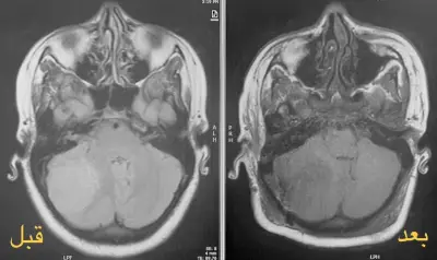 نجاح عملية استئصال ورم دماغي معقد لامرأة حامل في مدينة الملك سلمان الطبية