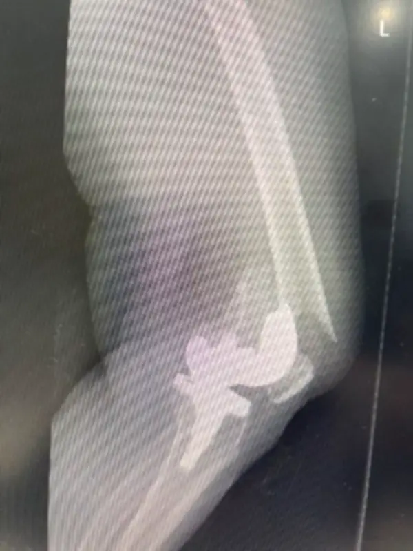 نجاح طبي بارز: مستشفى المانع – العزيزية يعيد قدرة المشي لمريضة مسنة بعد كسر معقد في الركبة