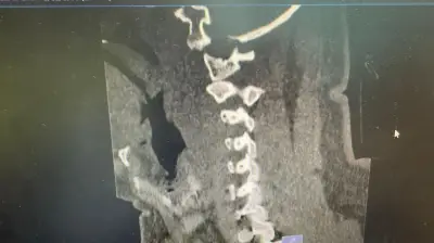 وزير الصحة السعودي يعلن عن إطلاق برنامج وطني للكشف المبكر عن السرطان