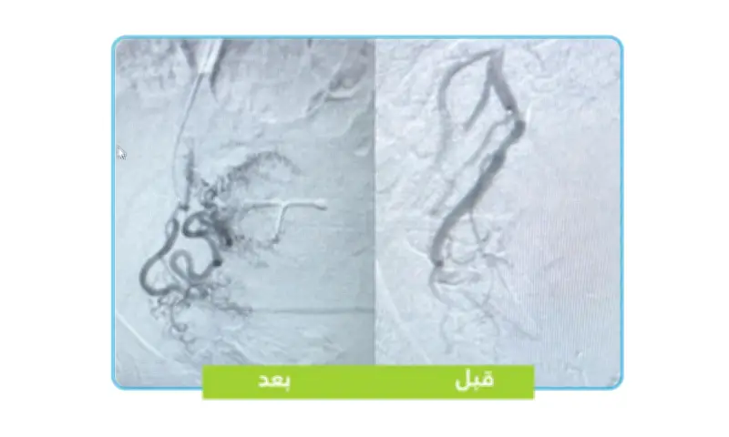 علاج مبتكر لتغدد الرحم بالأشعة التداخلية في مستشفى الإمام عبدالرحمن الفيصل