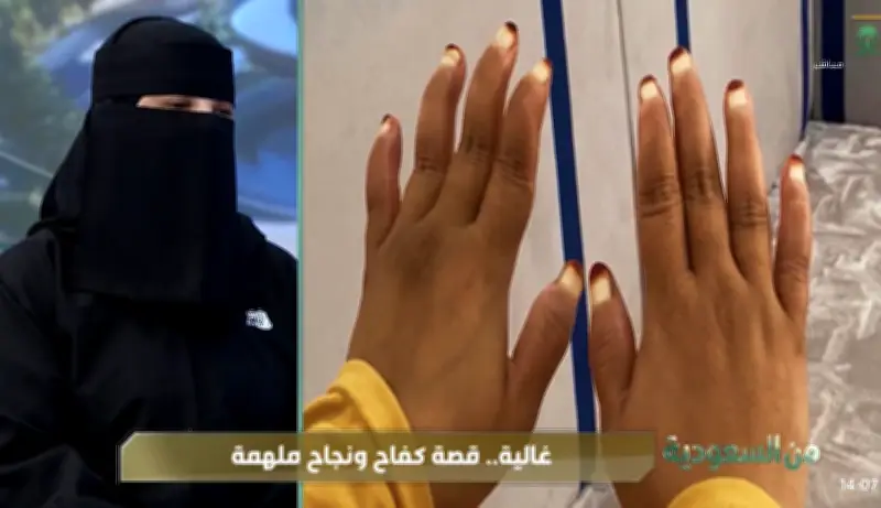 إنجاز طبي سعودي جديد.. زراعة قوقعة لطفلة دون سن العامين