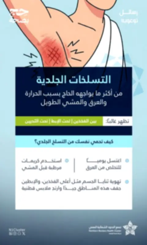 نصائح من تجمع الحدود الشمالية الصحي لتجنب التسلخات الجلدية للحجاج