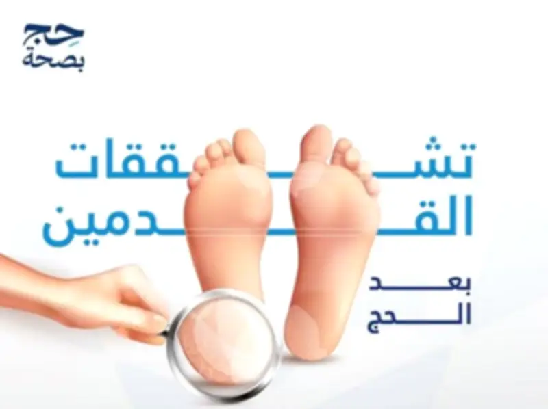 مدينة الملك عبدالله الطبية تحذر من تشقق القدمين بعد الحج وتقدم نصائح للعناية