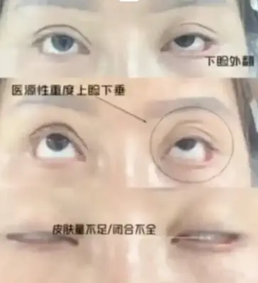 ضحية تجميل في الصين تواجه غرامة 400 ألف يوان بسبب شرط جزائي