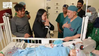 نجاح عملية فصل التوأم الفلبيني الملتصق في الرياض